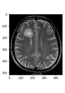 Beyin Tümörü MRI CNN